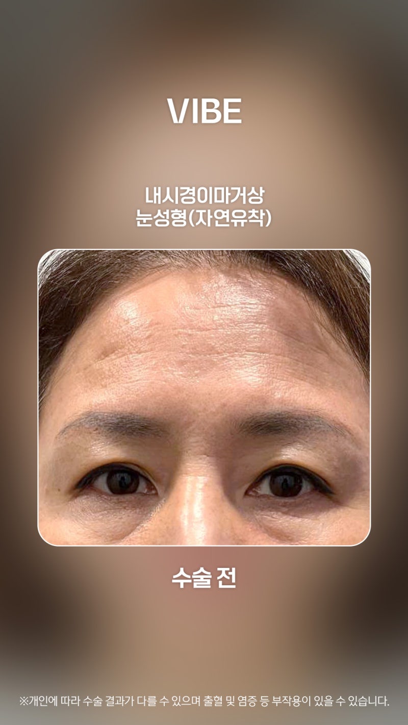 내시경이마거상과 눈성형으로 동안페이스 장착!