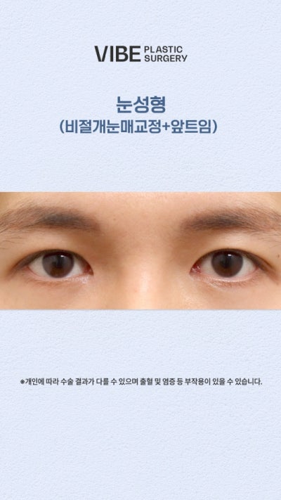 비절개눈매교정, 앞트임으로 졸린눈을 또렷하게!
