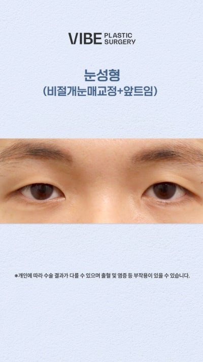 비절개눈매교정, 앞트임으로 졸린눈을 또렷하게! 사진 3