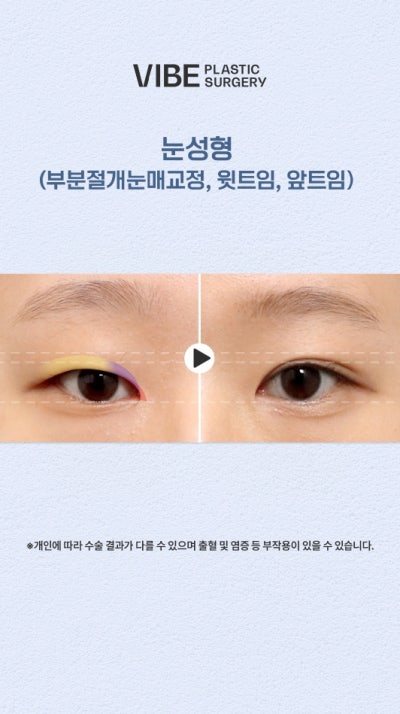 자연스러운 쌍꺼풀스타일도 바이브성형외과에서! 사진 3