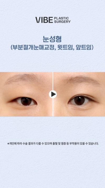 자연스러운 쌍꺼풀스타일도 바이브성형외과에서! 사진 2