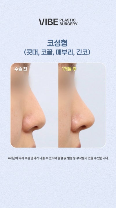 Kasus Hidung Panjang dan Ujung Hidung Turun, Cantik Tanpa Implan