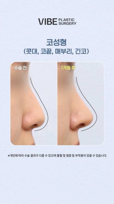 Kasus Hidung Panjang dan Ujung Hidung Turun, Cantik Tanpa Implan 사진 2