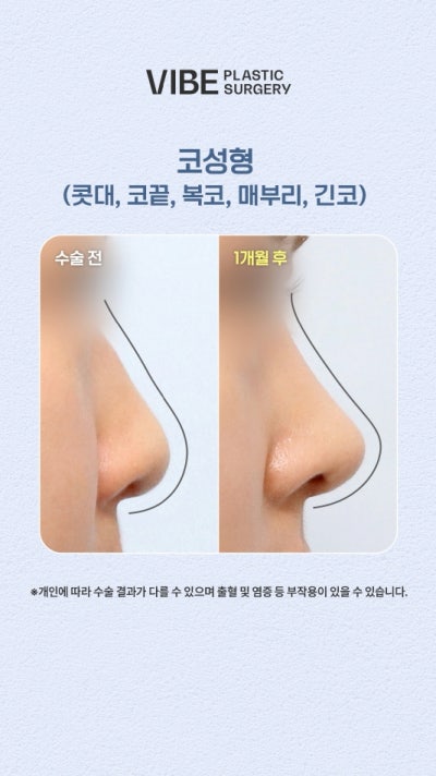 복코+매부리코+긴코 교정 전후