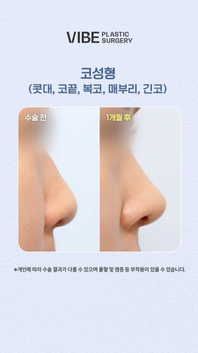 복코+매부리코+긴코 교정 전후