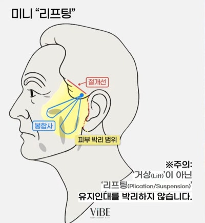 신논현 성형외과 바이브성형외과 LIVE 방송 출연 사진 17