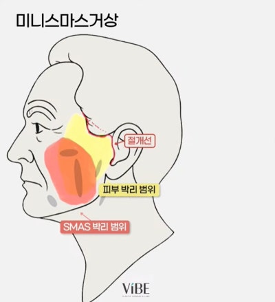 신논현 성형외과 바이브성형외과 LIVE 방송 출연 사진 16