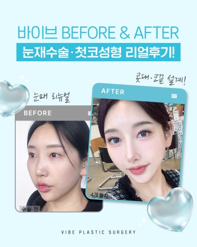 다시 선명해진 눈매와 첫 코성형의 조화,강남 코성형 바이브성형외과｜VIBE PICK 눈재수술·첫 코성형 케이스💜 사진 6