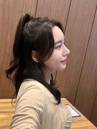 Natural Nose Line Achieved with First Rhinoplasty | VIBE PICK Hooked Nose & Bulbous Nose Correction at Sinnonhyeon VIBE 