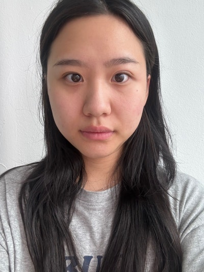 Natural Nose Line Achieved with First Rhinoplasty | VIBE PICK Hooked Nose & Bulbous Nose Correction at Sinnonhyeon VIBE 
