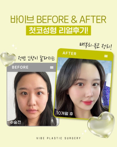 Natural Nose Line Achieved with First Rhinoplasty | VIBE PICK Hooked Nose & Bulbous Nose Correction at Sinnonhyeon VIBE 