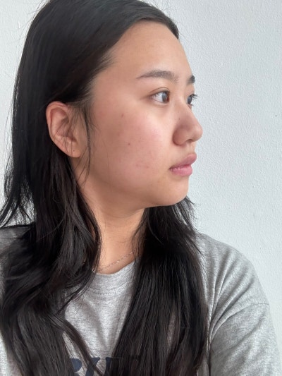 Natural Nose Line Achieved with First Rhinoplasty | VIBE PICK Hooked Nose & Bulbous Nose Correction at Sinnonhyeon VIBE 