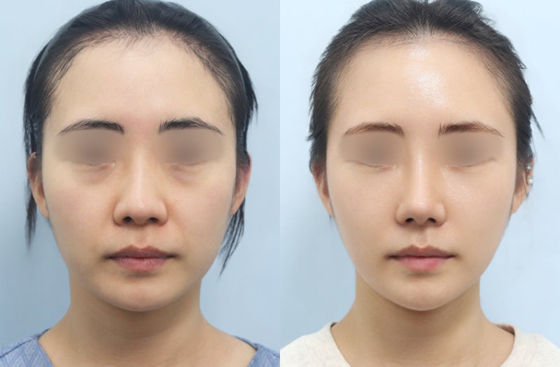 눈 밑만 밝혀도 인상이 달라진다? 강남 성형외과 바이브성형외과 시그니처 눈밑칙프팅 사진 7