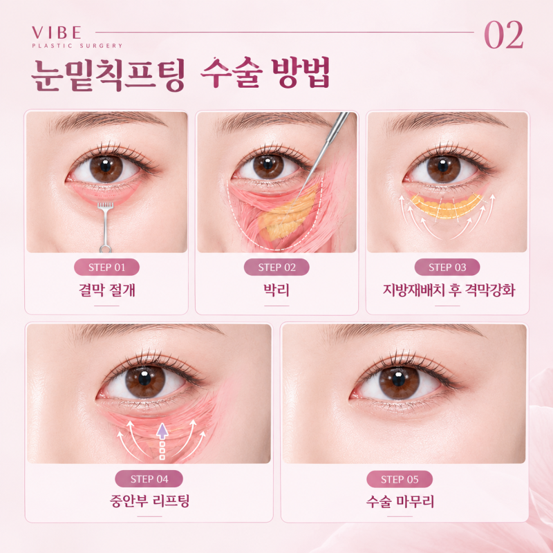 눈 밑만 밝혀도 인상이 달라진다? 강남 성형외과 바이브성형외과 시그니처 눈밑칙프팅 사진 3