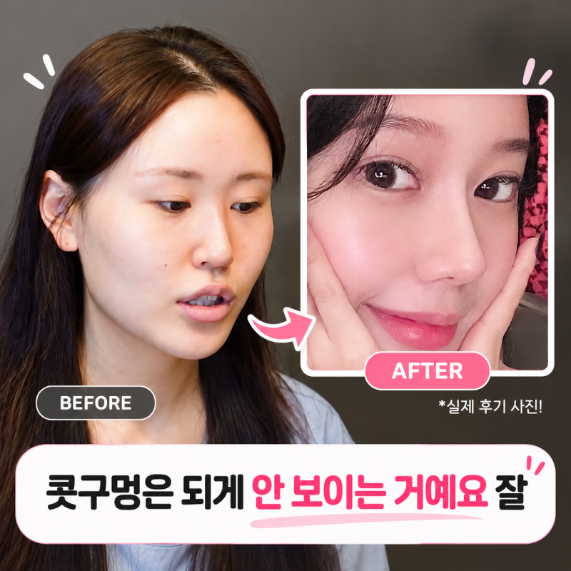 병원 한 군데만 상담받고 바로 수술했습니다! |신논현 코성형 브이로그 바이브성형외과